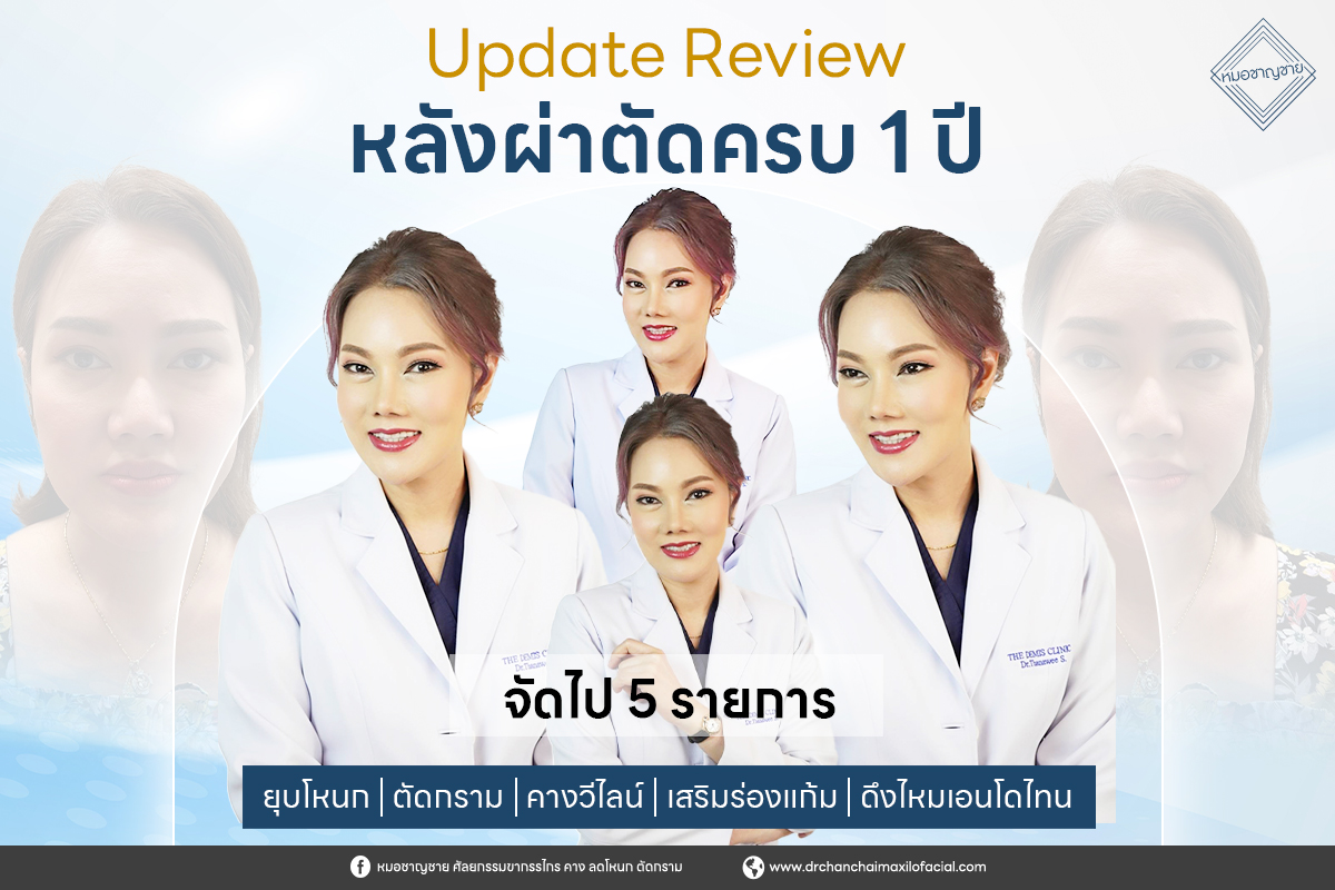 รีวิวยุบโหนก ตัดกราม คางวีไลน์ เสริมร่องแก้ม ดึงไหมเอนโดไทน