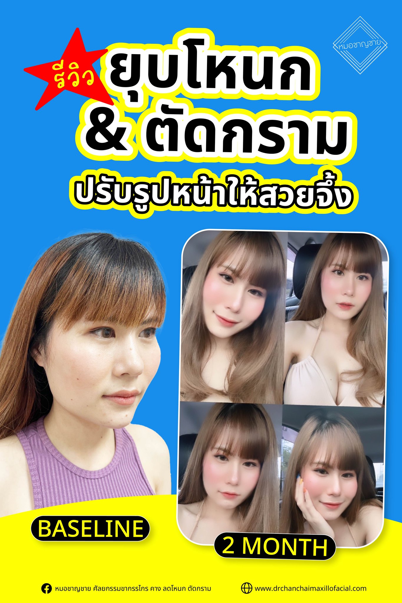 รีวิวผ่าตัดยุบโหนกแก้ม ตัดกราม ปรับรูปหน้าให้สวยจึ้ง