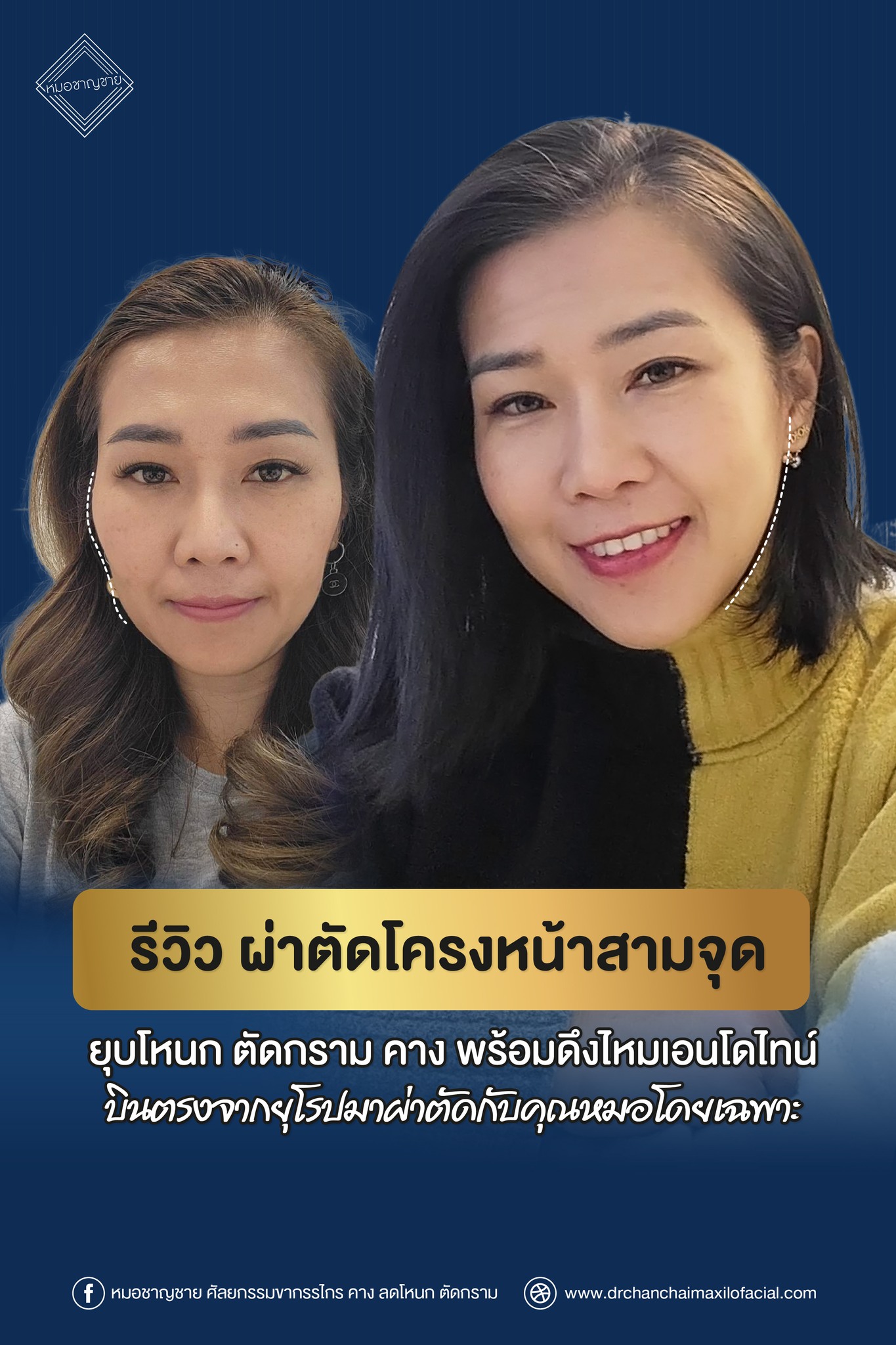 รีวิว ผ่าตัดโครงหน้าสามจุด