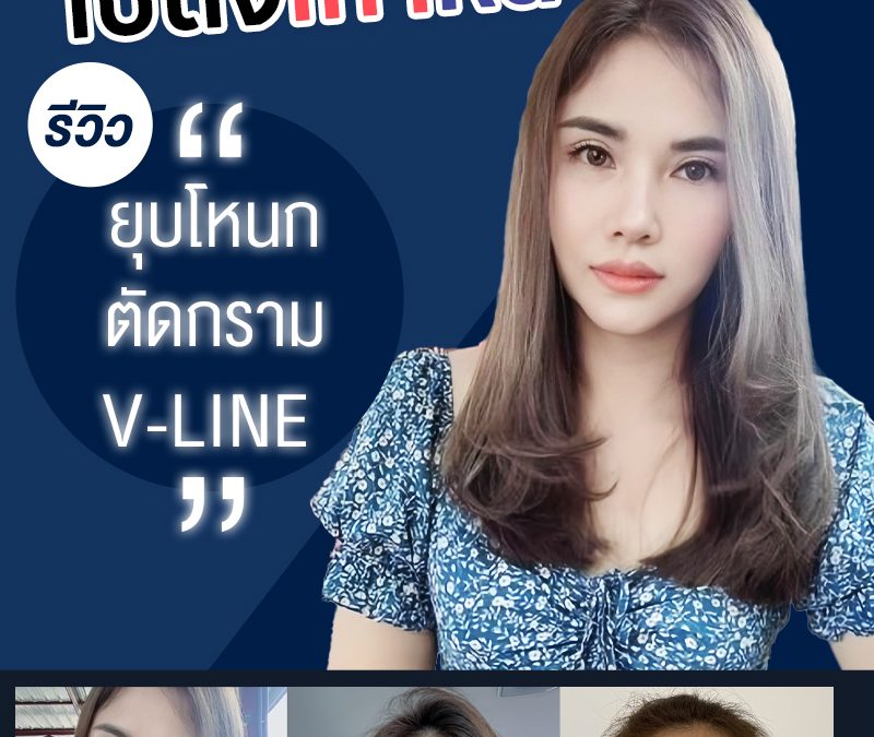 รีวิวยุบโหนก ตัดกราม V-LINE