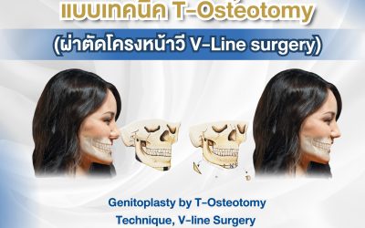 อยากหน้าเรียววีไลน์ แต่ปลอดภัยและโครงสร้างสวยธรรมชาติ