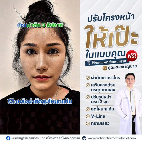 รีวิวหลังผ่าตัดยุบโหนกแก้ม