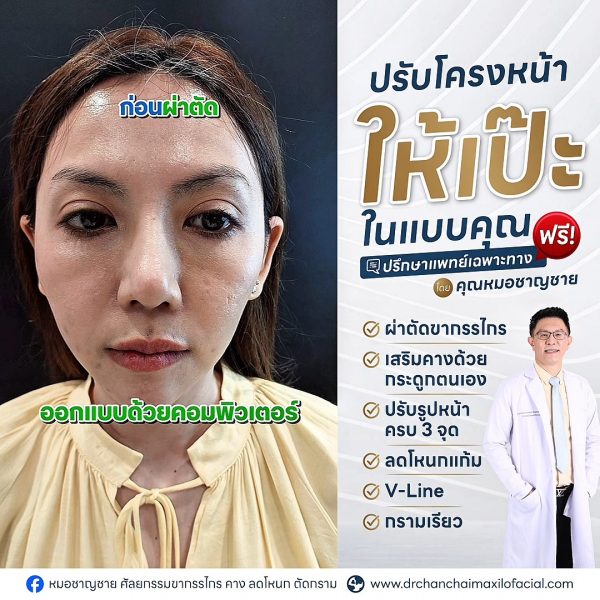 เสริมคาง