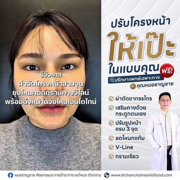 ผ่าตัดโครงหน้า