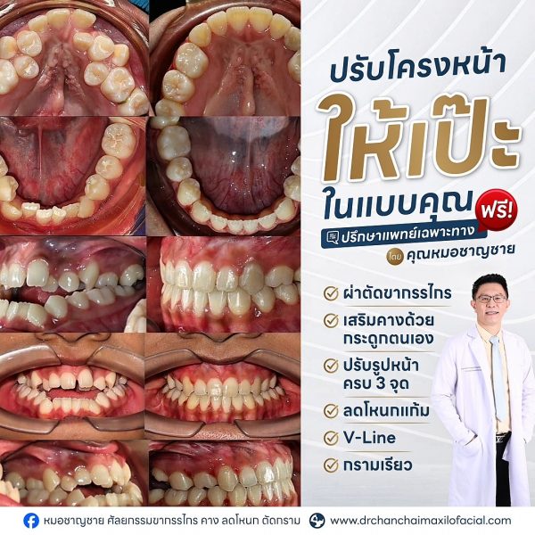 คางยื่น