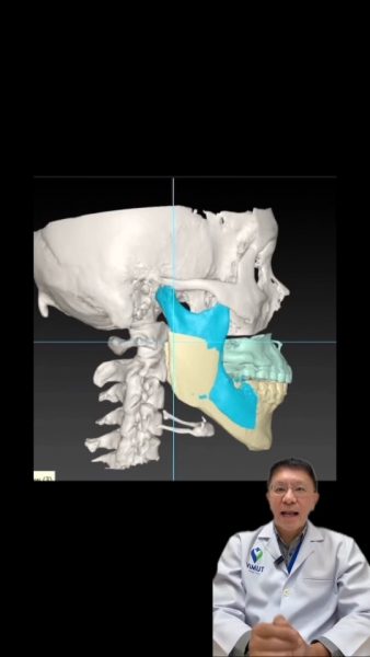 ผ่าตัดโครงหน้า