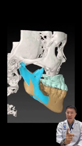 ผ่าตัดโครงหน้า