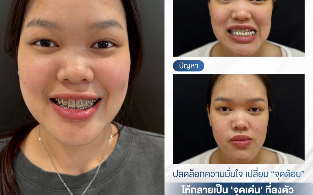 การผ่าตัดขากรรไกรและโครงหน้า ต้องอาศัยความเชี่ยวชาญระดับสูง