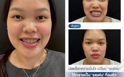 การผ่าตัดขากรรไกรและโครงหน้า ต้องอาศัยความเชี่ยวชาญระดับสูง