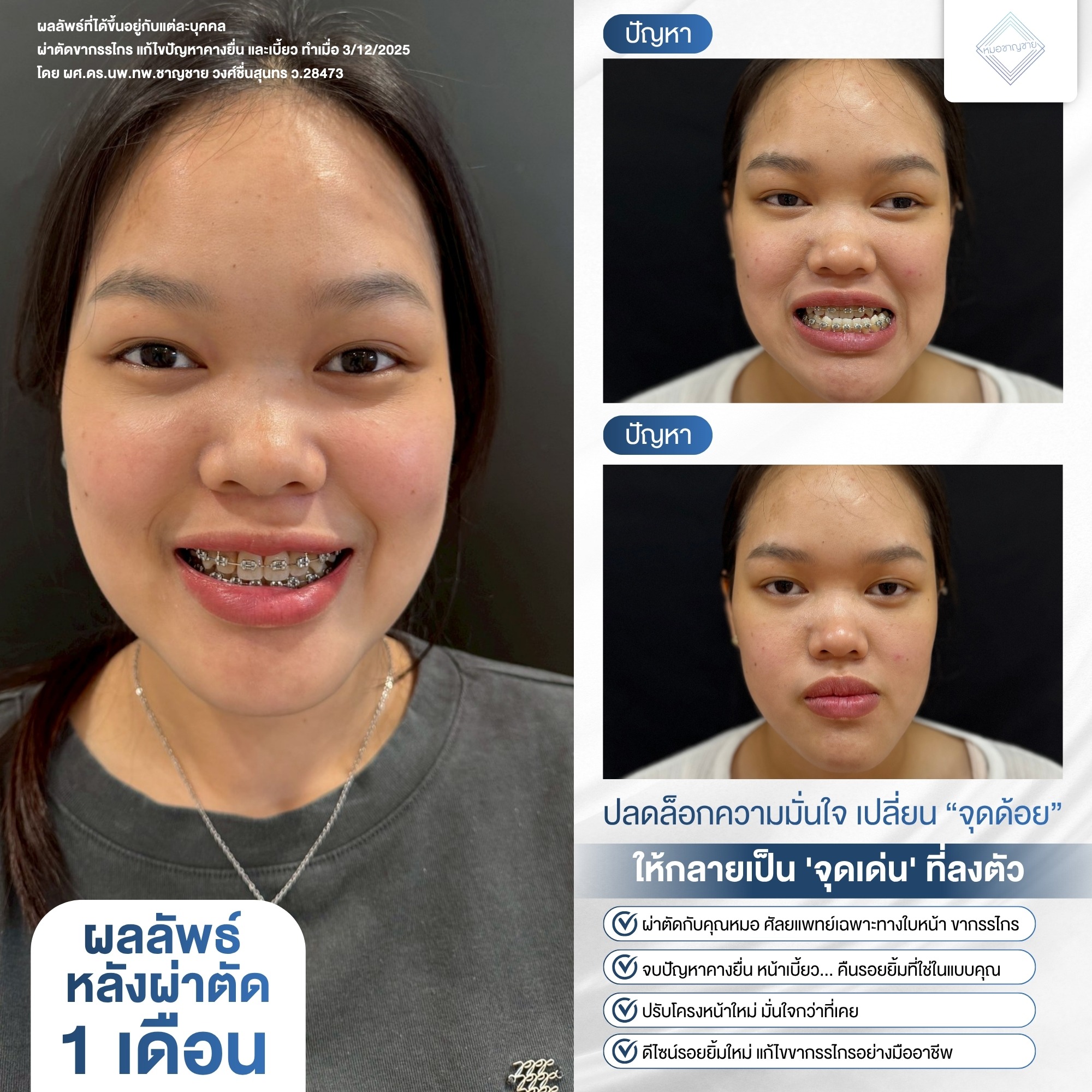 ผ่าตัดขากรรไกร