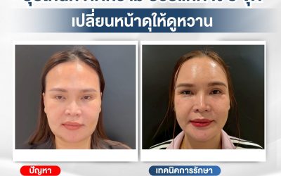 จบปัญหาหน้าดุ… สู่ใบหน้าเรียวสวยละมุน สวยครบ 3 จุด ไม่ต้องรอนาน