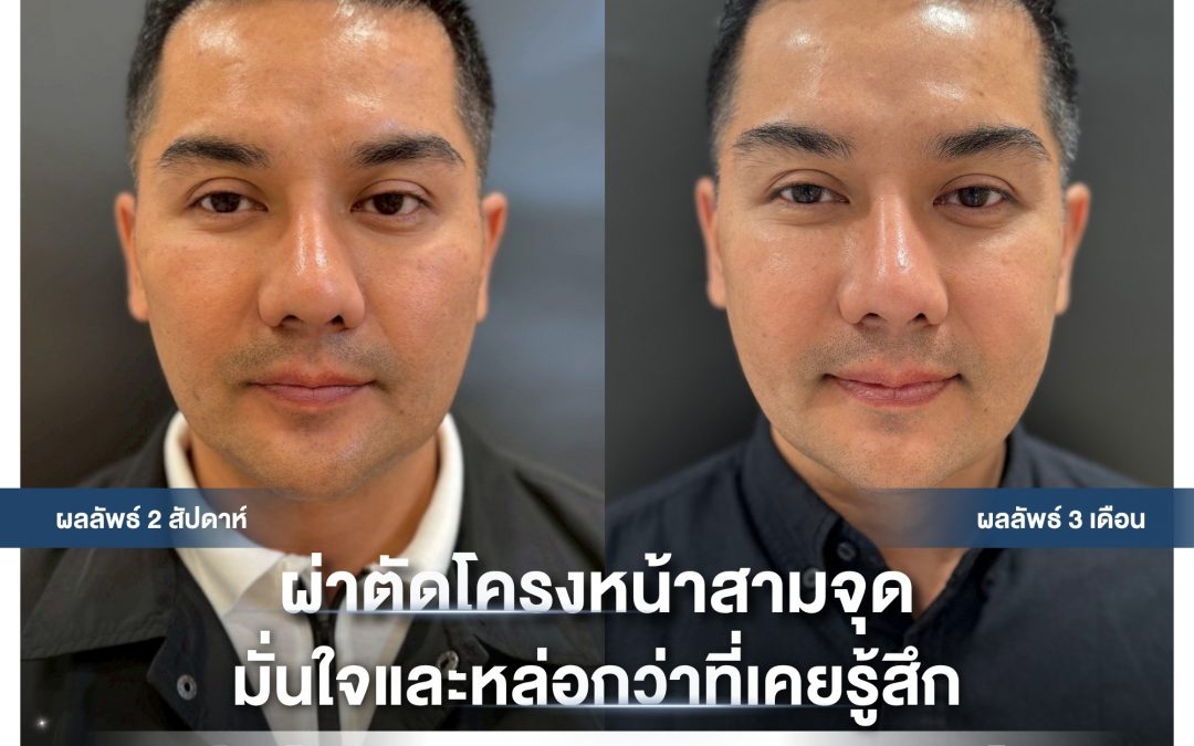 ปรับโครงหน้า 3 จุดสำคัญ หล่อและมั่นใจกว่าที่เคยรู้สึก