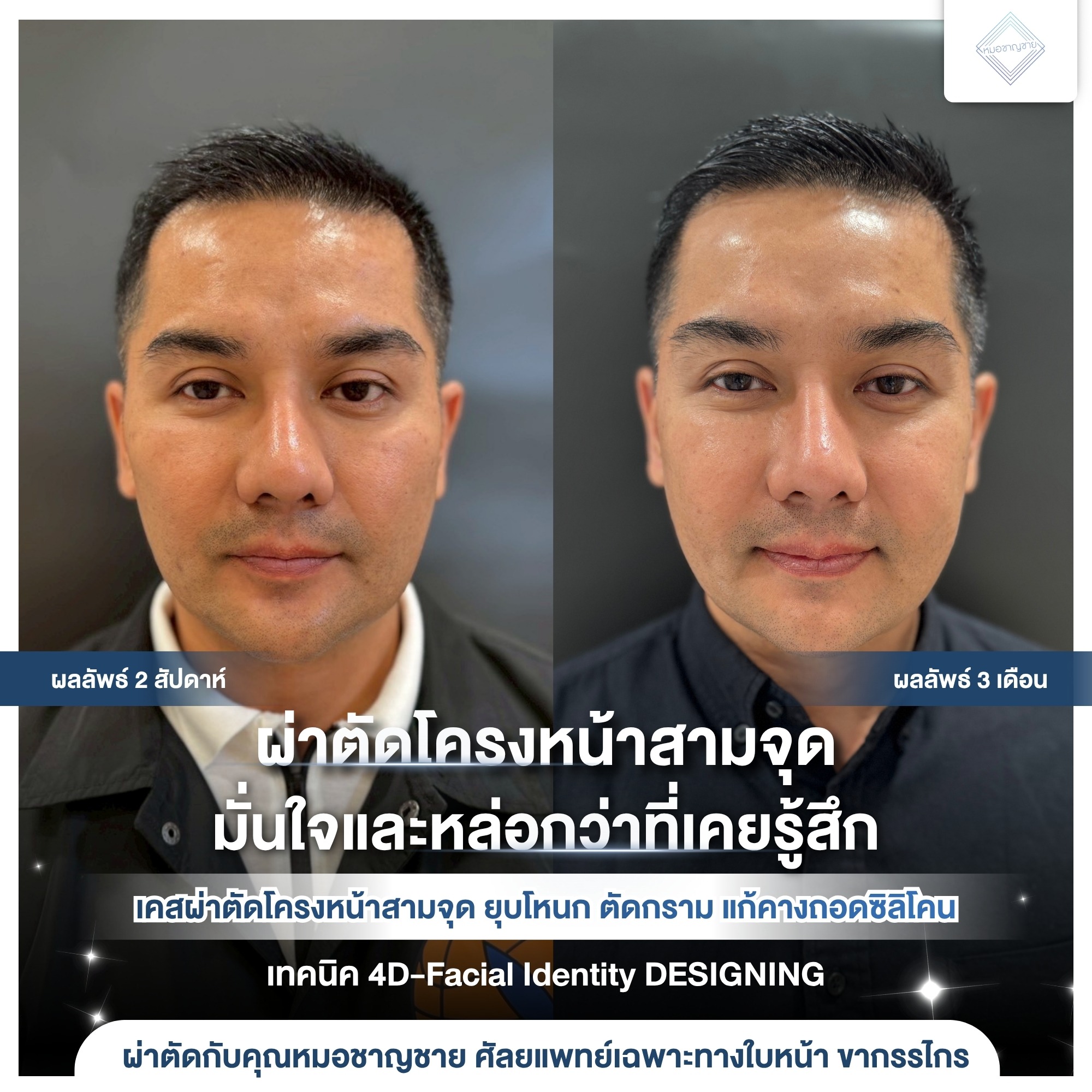 ปรับโครงหน้า