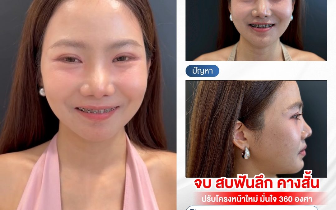 จบปัญหาสบฟันลึกและคางสั้น! ศัลยกรรมใบหน้าและขากรรไกร