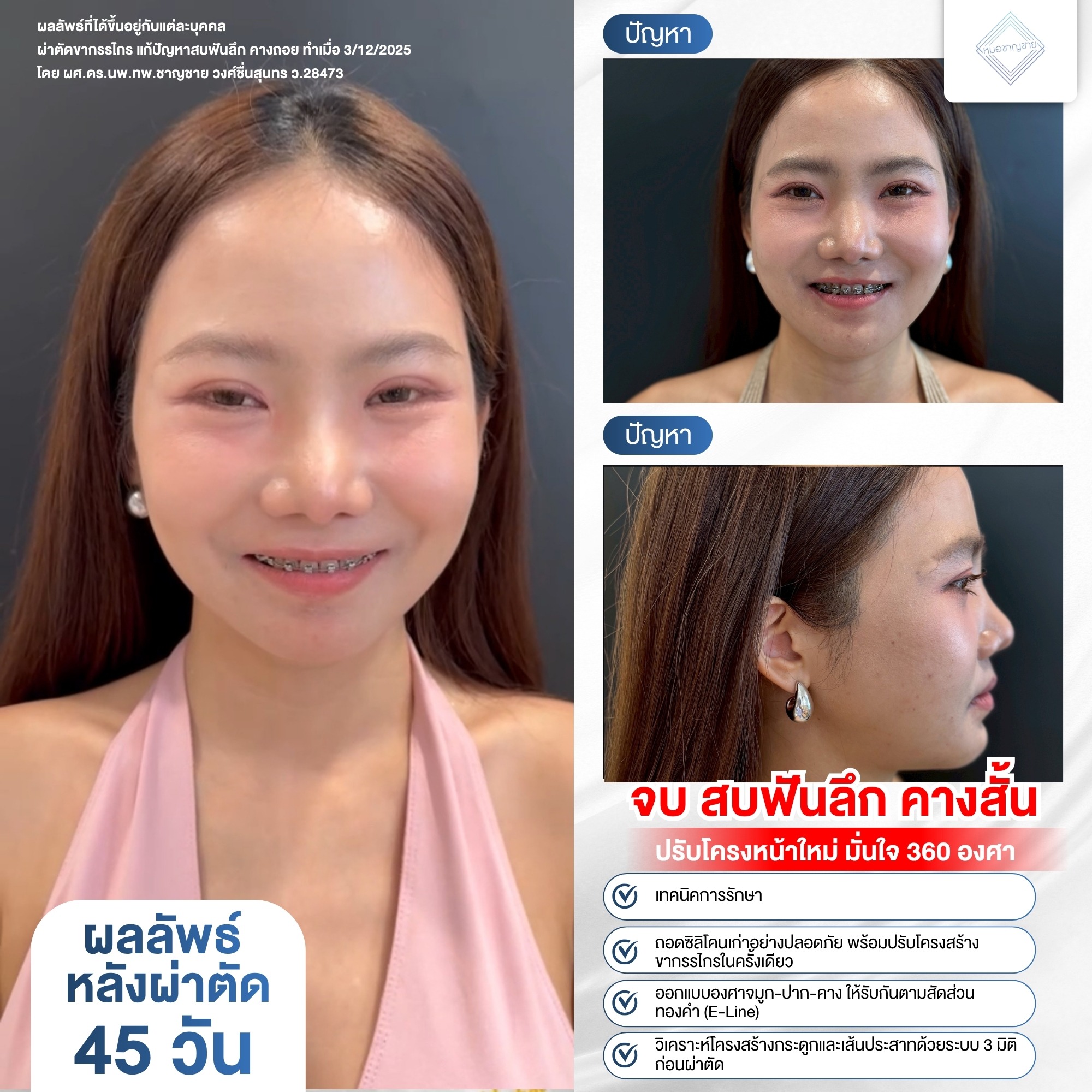 ปัญหาสบฟันลึก