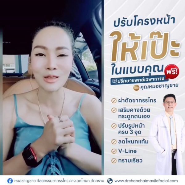 หลังลดโหนกแก้ม