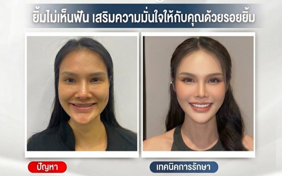 “เปลี่ยน ‘คางยื่น-ยิ้มไม่เห็นฟัน’ ให้เป็นรอยยิ้มที่มั่นใจและรูปหน้าที่สมส่วนครับ ✨