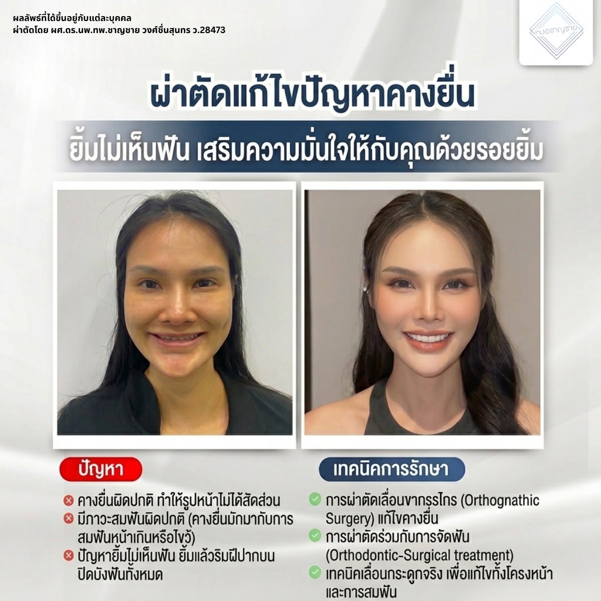 คางยื่น
