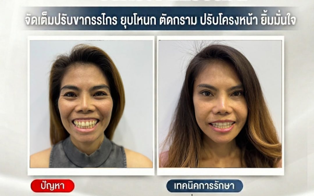 บินตรงจากเยอรมนี เพื่อมาดูแลโครงหน้ากับคุณหมอชาญชาย