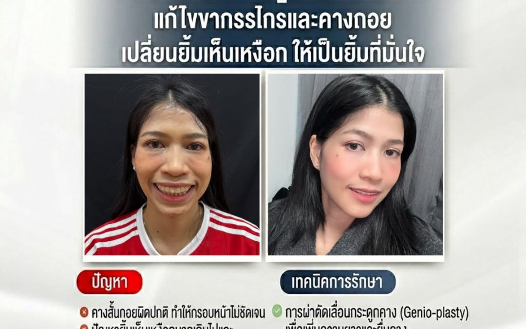 เปลี่ยนยิ้มเห็นเหงือก ให้เป็นยิ้มที่มั่นใจ