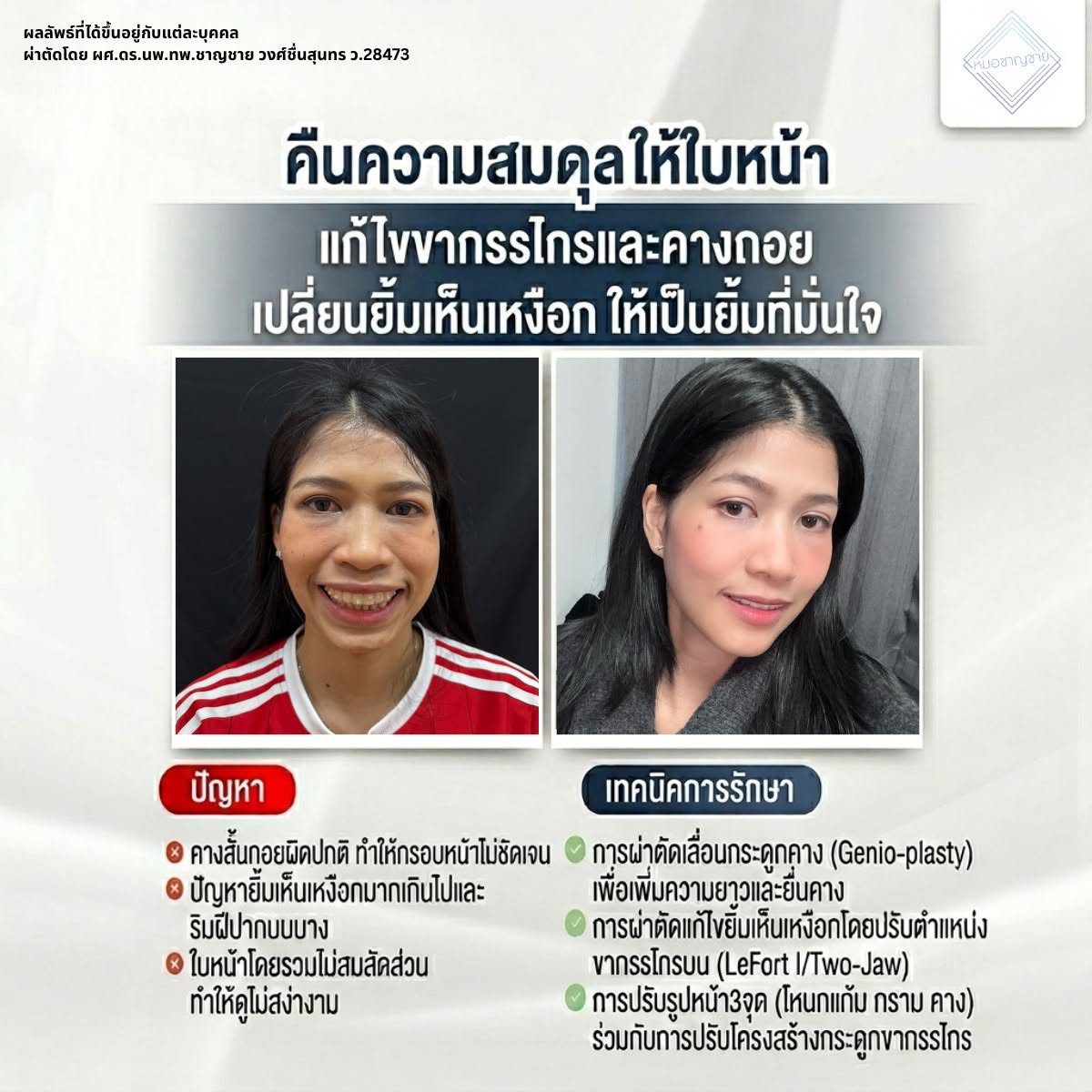 เปลี่ยนยิ้มเห็นเหงือก เปลี่ยนยิ้มเห็นเหงือก