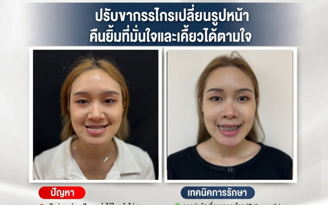 บอกลาปัญหาฟันล่างคร่อมฟันบน