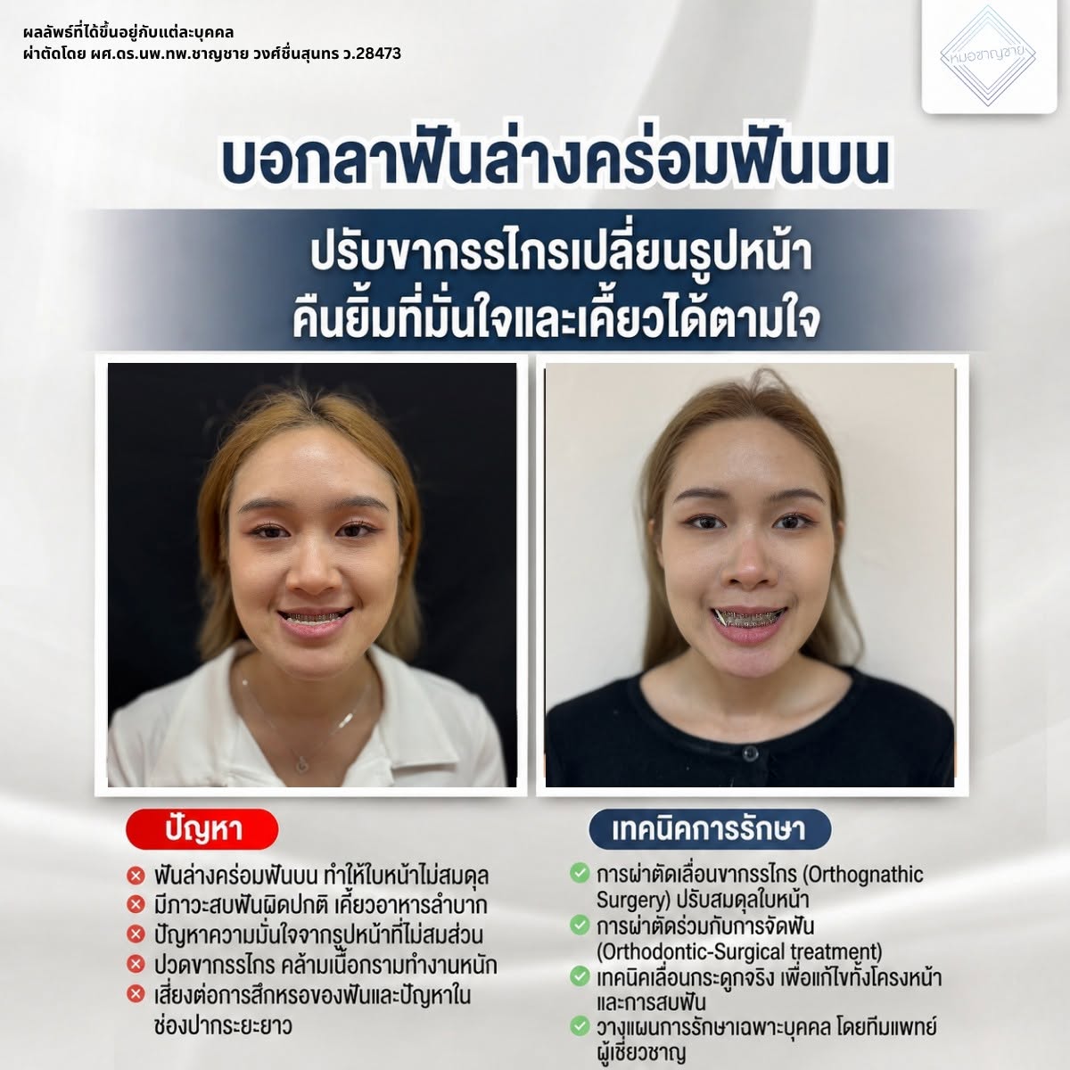 ฟันล่างคร่อมฟันบน ฟันล่างคร่อมฟันบน