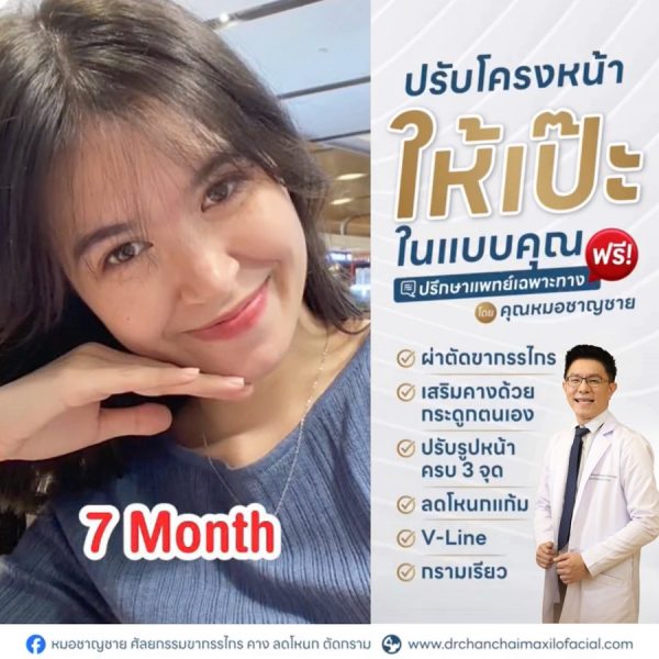 ผ่าตัดโครงหน้า
