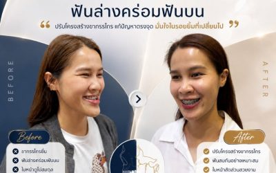 รีวิวเคสขากรรไกรยื่น ฟันล่างคร่อมฟันบน