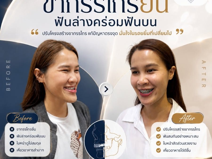 รีวิวเคสขากรรไกรยื่น ฟันล่างคร่อมฟันบน