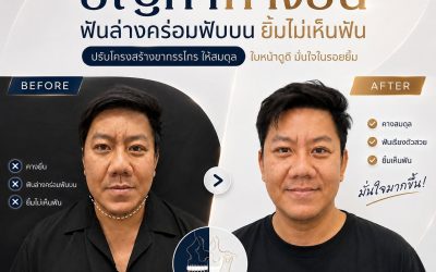 คางยื่น ฟันล่างคร่อมฟันบน ยิ้มแล้วไม่ค่อยเห็นฟัน…