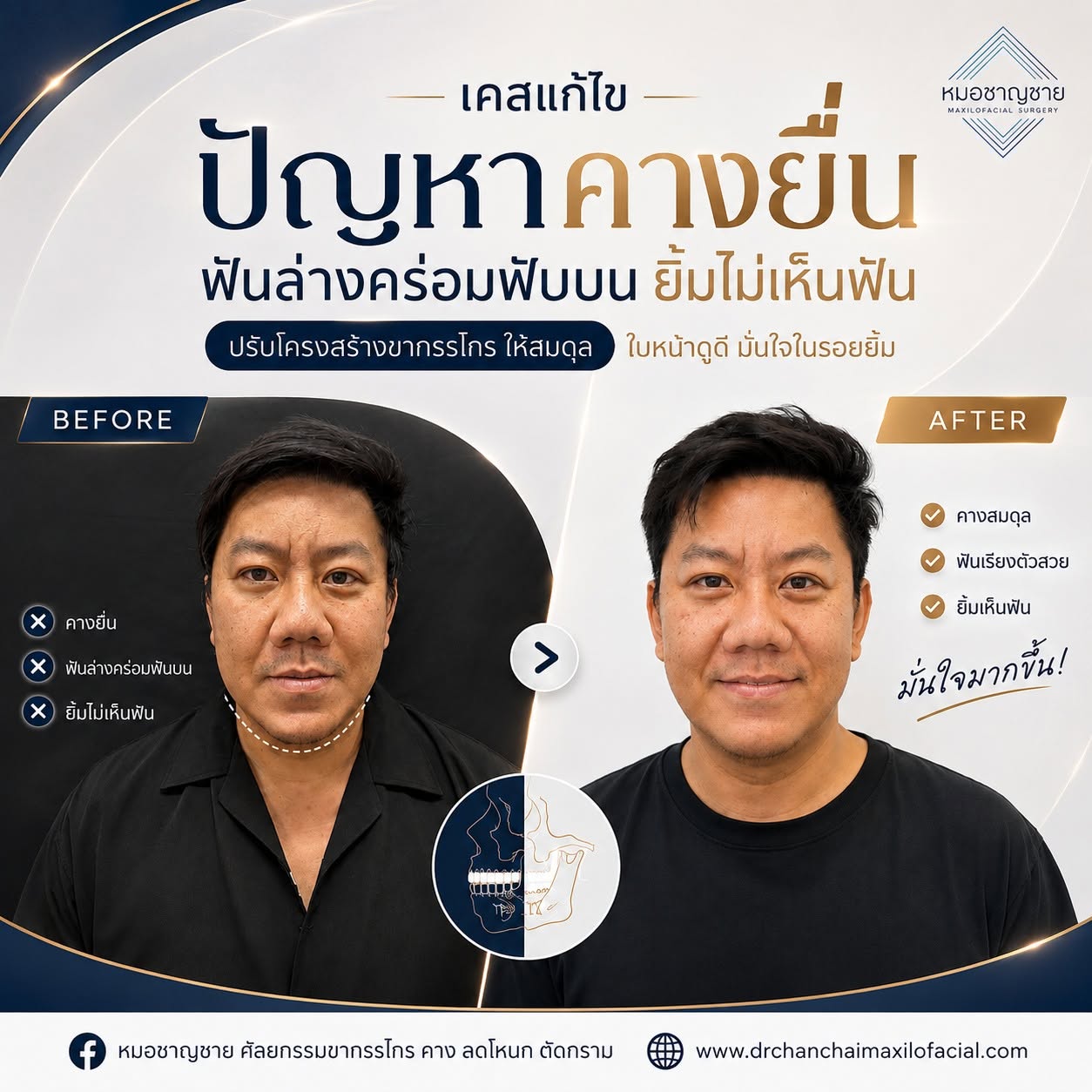ฟันล่างคร่อมฟันบน ฟันล่างคร่อมฟันบน