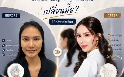 ปัญหาคางยื่น ยิ้มไม่เห็นฟัน สู่รอยยิ้มที่มั่นใจในทุกมุมมอง