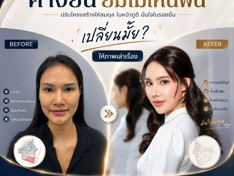 ปัญหาคางยื่น ยิ้มไม่เห็นฟัน สู่รอยยิ้มที่มั่นใจในทุกมุมมอง