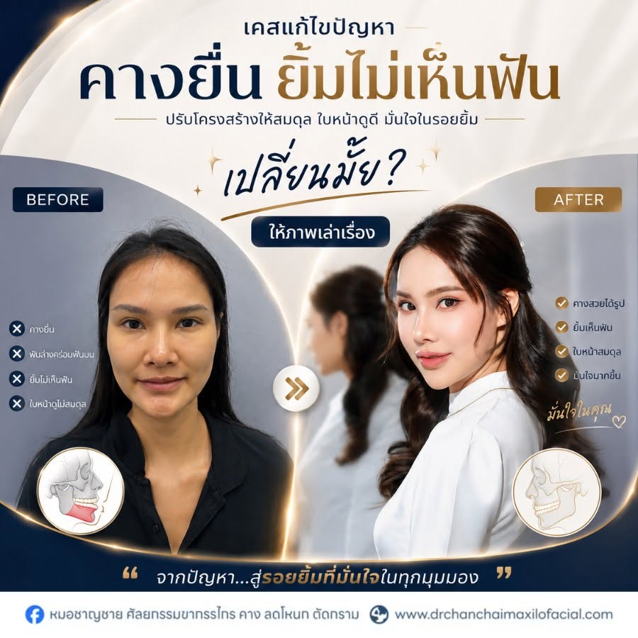 ปัญหาคางยื่น ปัญหาคางยื่น