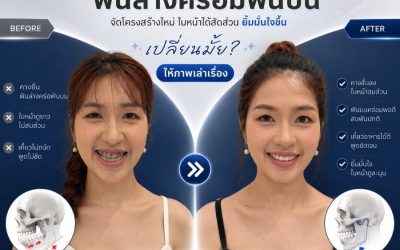 ปัญหาคางยื่น ฟันล่างคร่อมฟันบน จัดโครงสร้างใหม่