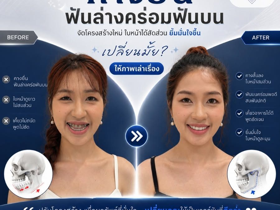 ปัญหาคางยื่น ฟันล่างคร่อมฟันบน จัดโครงสร้างใหม่