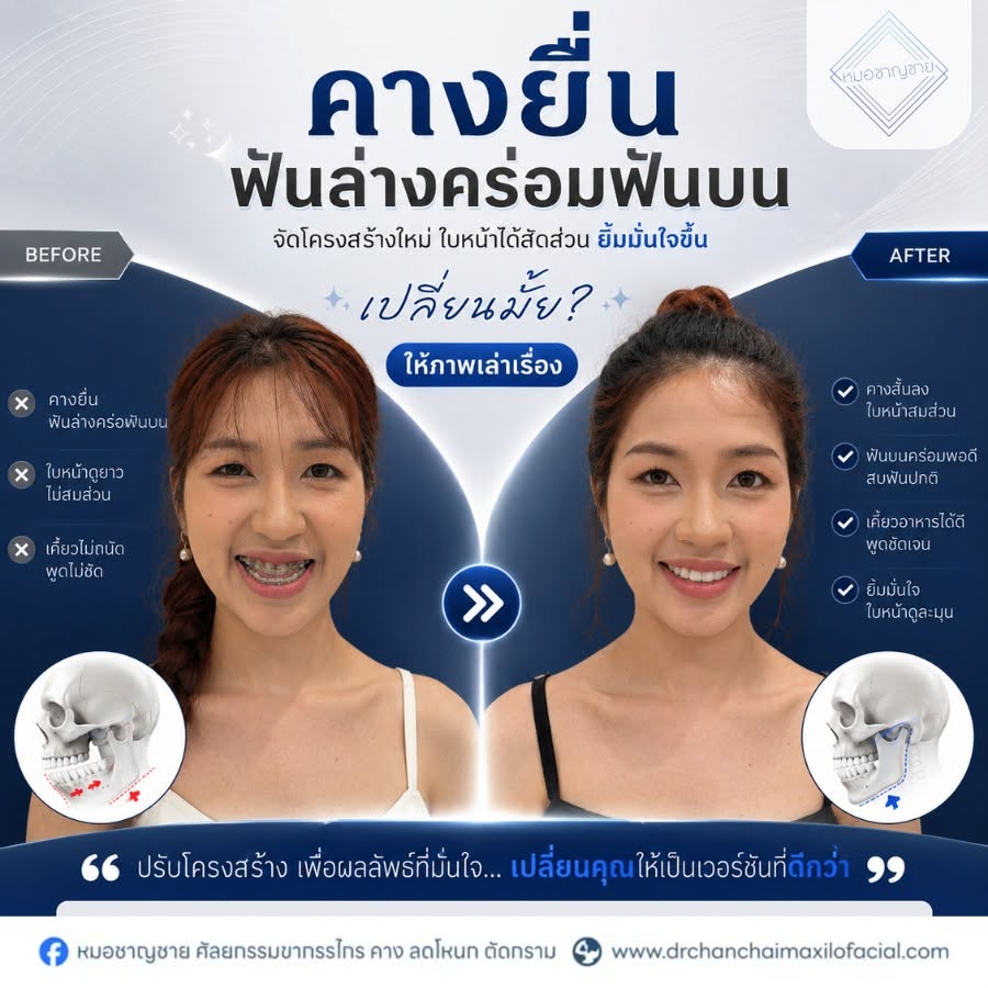 ฟันล่างคร่อมฟันบน