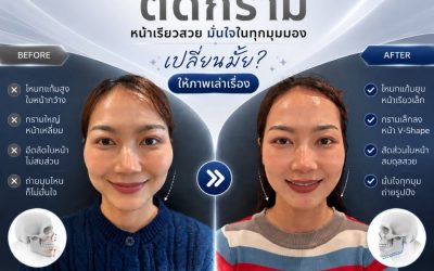 ยุบโหนก ตัดกราม เปลี่ยนหน้าเหลี่ยมกว้าง ให้เป็นหน้าเรียวสวย
