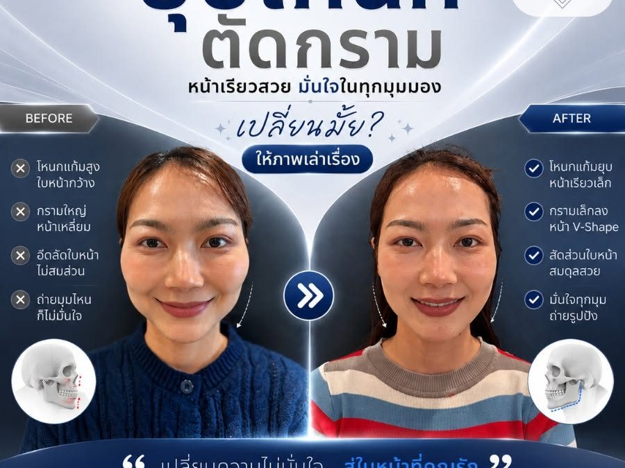 ยุบโหนก ตัดกราม เปลี่ยนหน้าเหลี่ยมกว้าง ให้เป็นหน้าเรียวสวย