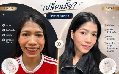 ปัญหาปากอูม ยิ้มเห็นเหงือก คางถอย สู่รอยยิ้มที่มั่นใจในเวอร์ชั่นที่ดีที่สุดของคุณ