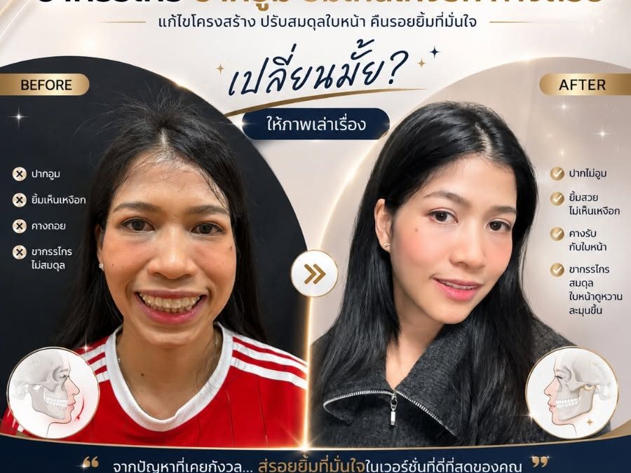 ปัญหาปากอูม ยิ้มเห็นเหงือก คางถอย สู่รอยยิ้มที่มั่นใจในเวอร์ชั่นที่ดีที่สุดของคุณ
