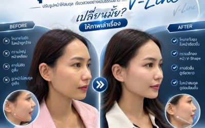 ยุบโหนก ตัดกราม พร้อมปรับรูปหน้าให้สมดุลมากขึ้น