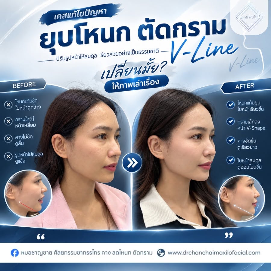 ยุบโหนก ยุบโหนก