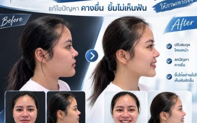 เคสนี้มีปัญหา คางยื่น และยิ้มเห็นฟันได้น้อย