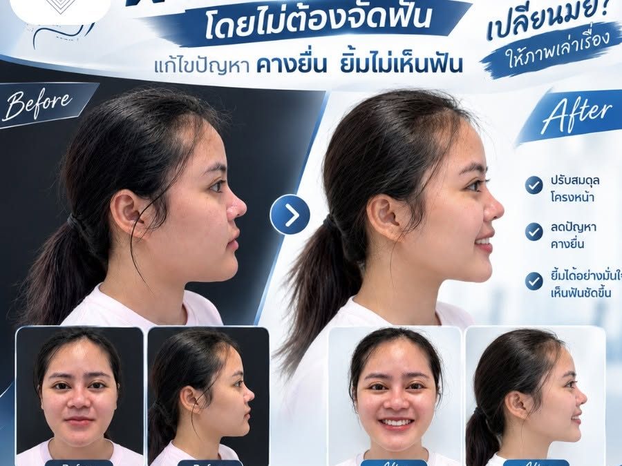 เคสนี้มีปัญหา คางยื่น และยิ้มเห็นฟันได้น้อย